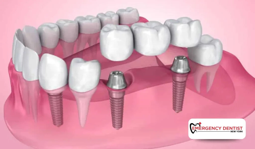 What Affects the Cost of Dental Implants