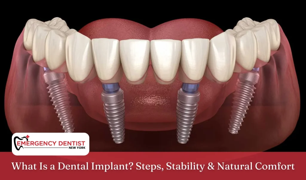 What Is a Dental Implant Steps, Stability & Natural Comfort